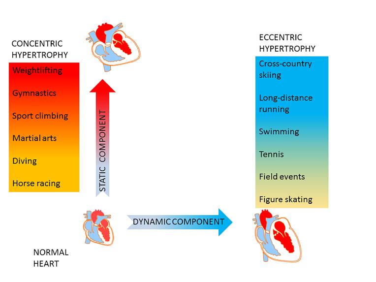 Heart failure in athletes pathophysiology and diagnostic management